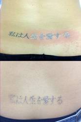 до и после первой процедуры лазерного удаления тату